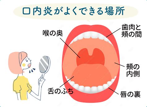 口穴|口内炎で穴が空く？悪化する口内炎の原因 